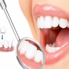 Tìm hiểu răng sứ là gì? Trường hợp nào nên bọc răng sứ