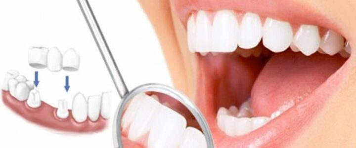 Tìm hiểu răng sứ là gì? Trường hợp nào nên bọc răng sứ