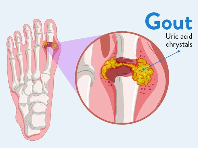 Bệnh Gout liên quan đến tăng axit uric máu, vì vậy chế độ ăn đóng vai trò quan trọng trong kiểm soát bệnh
