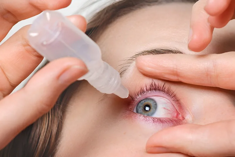 Người bị đau mắt đỏ không nên tự ý sử dụng thuốc nhỏ mắt, đặc biệt là kháng sinh hoặc thuốc chứa corticosteroid khi chưa được đánh giá nguyên nhân.