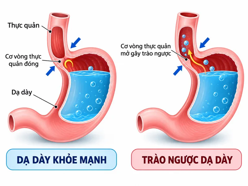 Trào ngược dạ dày xảy ra khi axit và dịch tiêu hóa di chuyển ngược lên thực quản, gây cảm giác khó chịu.
